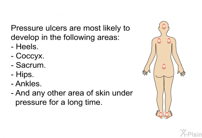 Pressure ulcers are most likely to develop in the following areas:  Heels. Coccyx. Sacrum. Hips. Ankles. And any other area of skin under pressure for a long time.