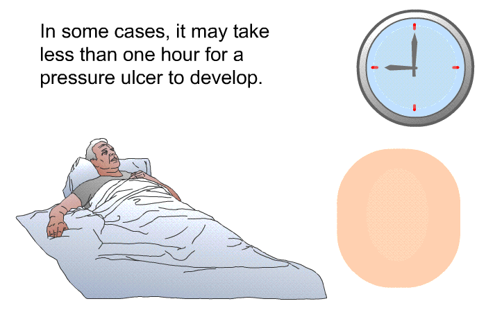 In some cases, it may take less than one hour for a pressure ulcer to develop.