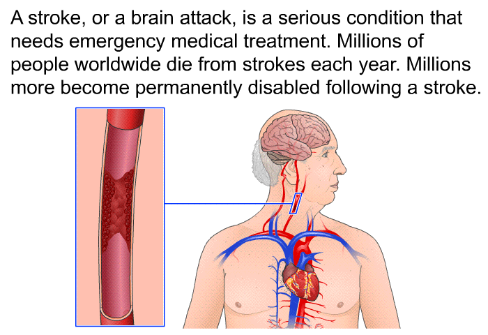 A stroke, or a brain attack, is a serious condition that needs emergency medical treatment. Millions of people worldwide die from strokes each year. Millions more become permanently disabled following a stroke.