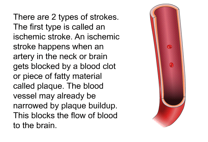 There are 2 types of strokes. The first type is called an ischemic stroke. An ischemic stroke happens when an artery in the neck or brain gets blocked by a blood clot or piece of fatty material called plaque. The blood vessel may already be narrowed by plaque buildup. This blocks the flow of blood to the brain.