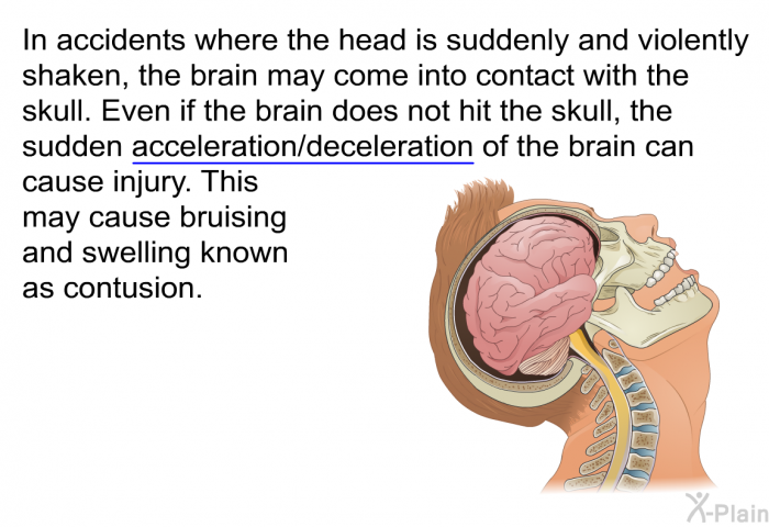 In accidents where the head is suddenly and violently shaken, the brain may come into contact with the skull. Even if the brain does not hit the skull, the sudden acceleration/deceleration of the brain can cause injury. This may cause bruising and swelling known as contusion.
