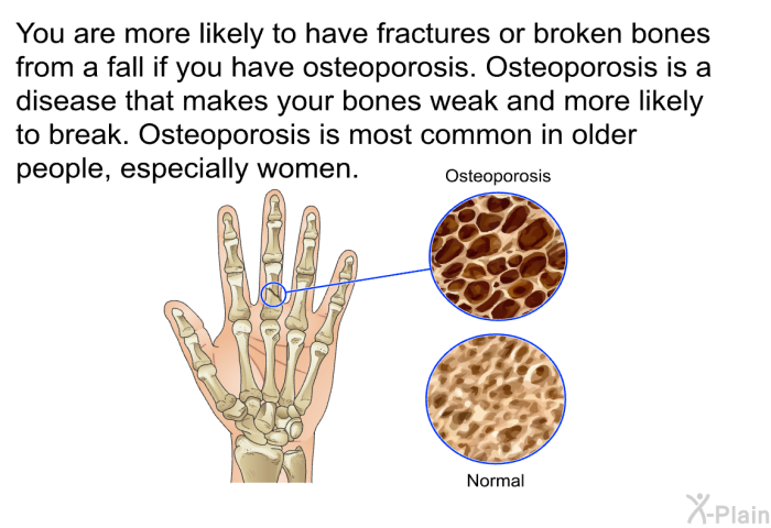 You are more likely to have fractures or broken bones from a fall if you have osteoporosis. Osteoporosis is a disease that makes your bones weak and more likely to break. Osteoporosis is most common in older people, especially women.