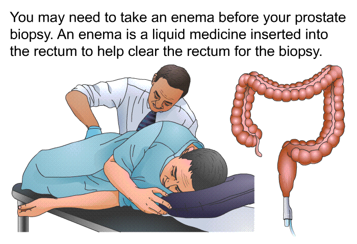 You may need to take an enema before your prostate biopsy. An enema is a liquid medicine inserted into the rectum to help clear the rectum for the biopsy.
