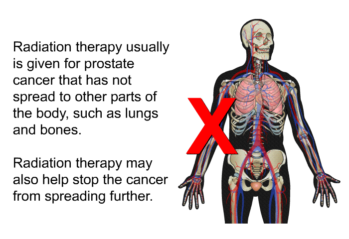 Radiation therapy usually is given for prostate cancer that has not spread to other parts of the body, such as lungs and bones. Radiation therapy may also help stop the cancer from spreading further.