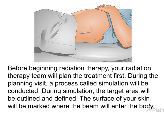 Before beginning radiation therapy, your radiation therapy team will plan the treatment first. During the planning visit, a process called simulation will be conducted. During simulation, the target area will be outlined and defined. The surface of your skin will be marked where the beam will enter the body.