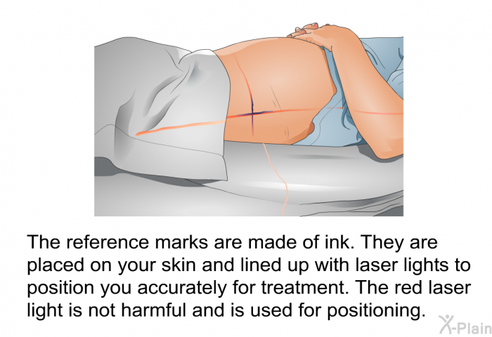 The reference marks are made of ink. They are placed on your skin and lined up with laser lights to position you accurately for treatment. The red laser light is not harmful and is used for positioning.