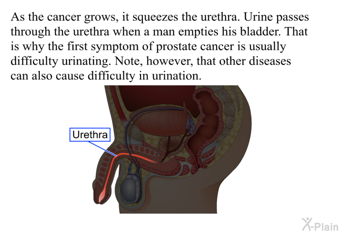As the cancer grows, it squeezes the urethra. Urine passes through the urethra when a man empties his bladder. That is why the first symptom of prostate cancer is usually difficulty urinating. Note, however, that other diseases can also cause difficulty in urination.