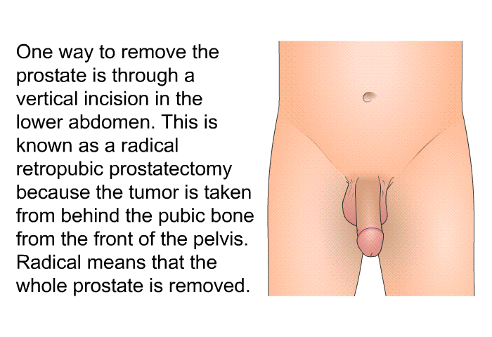 One way to remove the prostate is through a vertical incision in the lower abdomen. This is known as a radical retropubic prostatectomy because the tumor is taken from behind the pubic bone from the front of the pelvis. Radical means that the whole prostate is removed.