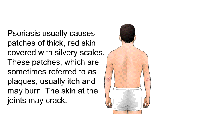 Psoriasis usually causes patches of thick, red skin covered with silvery scales. These patches, which are sometimes referred to as <I>plaques</I>, usually itch and may burn. The skin at the joints may crack.