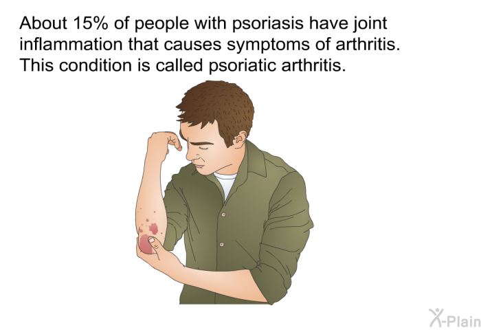 About 15% of people with psoriasis have joint inflammation that causes symptoms of arthritis. This condition is called <I>psoriatic arthritis</I>.