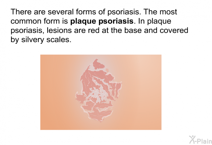 There are several forms of psoriasis. The most common form is <I><B>plaque psoriasis</B></I>. In plaque psoriasis, lesions are red at the base and covered by silvery scales.