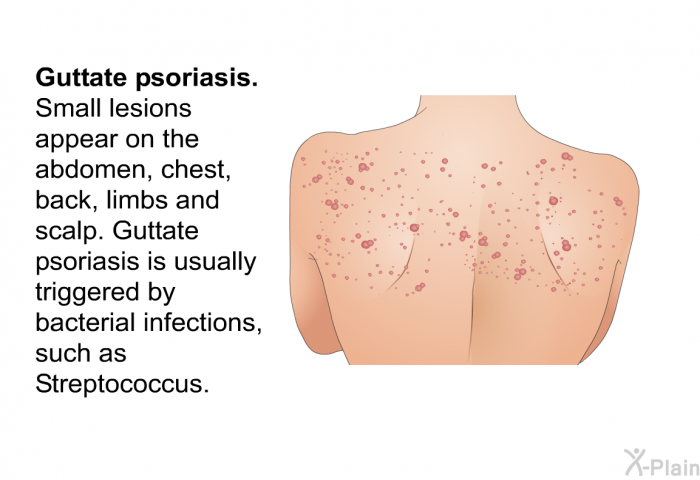<I><B>Guttate psoriasis</B></I>. Small lesions appear on the abdomen, chest, back, limbs and scalp. Guttate psoriasis is usually triggered by bacterial infections, such as <I>Streptococcus</I>.