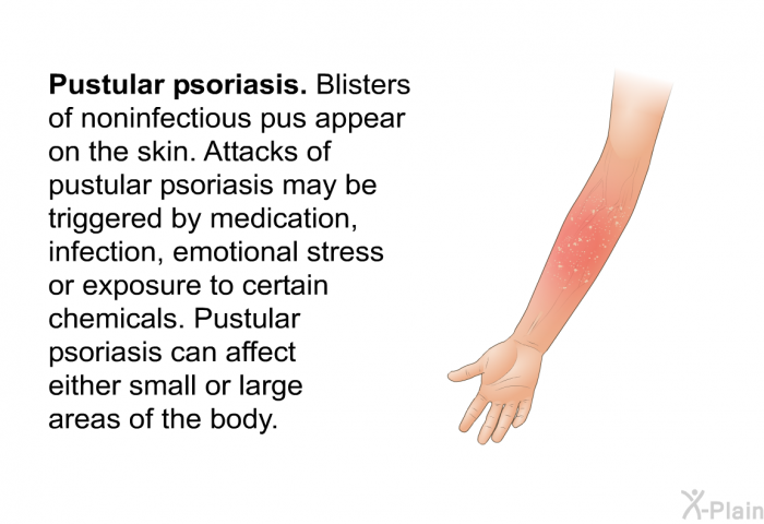 <I><B>Pustular psoriasis</B></I>. Blisters of noninfectious pus appear on the skin. Attacks of pustular psoriasis may be triggered by medication, infection, emotional stress or exposure to certain chemicals. Pustular psoriasis can affect either small or large areas of the body.