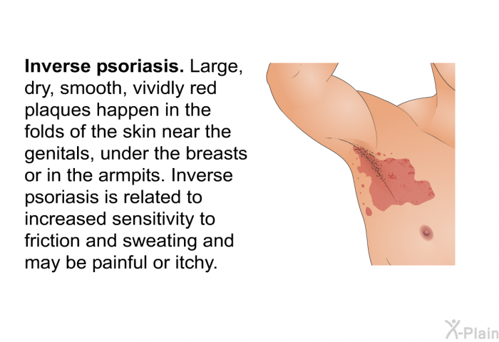 <I><B>Inverse psoriasis</B></I>. Large, dry, smooth, vividly red plaques happen in the folds of the skin near the genitals, under the breasts or in the armpits. Inverse psoriasis is related to increased sensitivity to friction and sweating and may be painful or itchy.