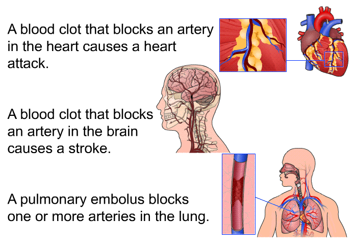 A blood clot that blocks an artery in the heart causes a heart attack. A blood clot that blocks an artery in the brain causes a stroke. A pulmonary embolus blocks one or more arteries in the lung.