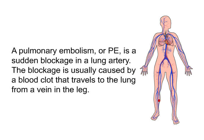 A pulmonary embolism, or PE, is a sudden blockage in a lung artery. The blockage is usually caused by a blood clot that travels to the lung from a vein in the leg.