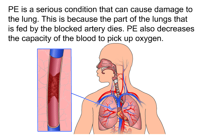 PE is a serious condition that can cause damage to the lung. This is because the part of the lungs that is fed by the blocked artery dies. PE also decreases the capacity of the blood to pick up oxygen.