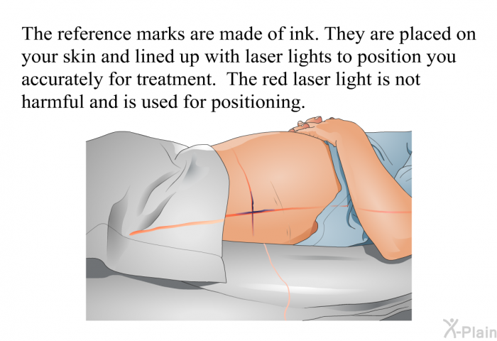 The reference marks are made of ink. They are placed on your skin and lined up with laser lights to position you accurately for treatment. The red laser light is not harmful and is used for positioning.