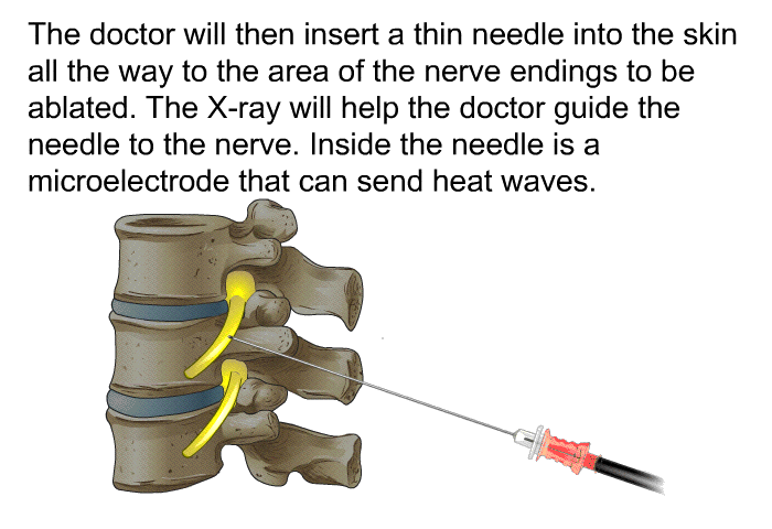 The doctor will then insert a thin needle into the skin all the way to the area of the nerve endings to be ablated. The X-ray will help the doctor guide the needle to the nerve. Inside the needle is a microelectrode that can send heat waves.