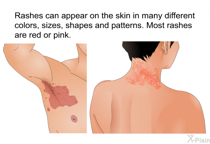 Rashes can appear on the skin in many different colors, sizes, shapes and patterns. Most rashes are red or pink.