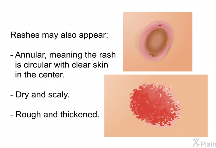 Rashes may also appear:  Annular, meaning the rash is circular with clear skin in the center. Dry and scaly. Rough and thickened.