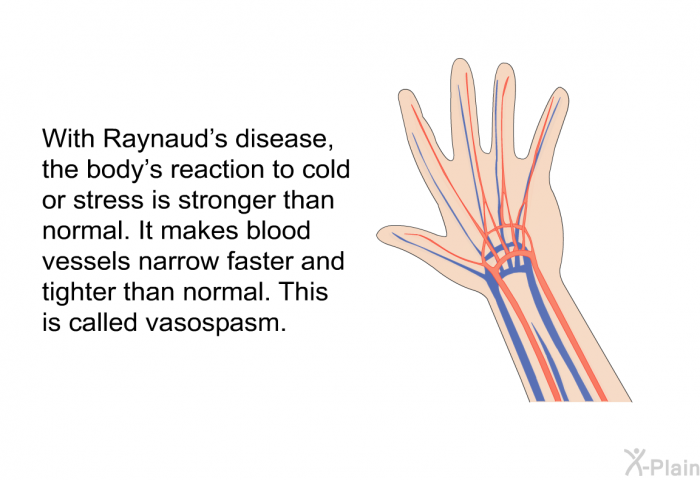 With Raynaud's disease, the body's reaction to cold or stress is stronger than normal. It makes blood vessels narrow faster and tighter than normal. This is called vasospasm.