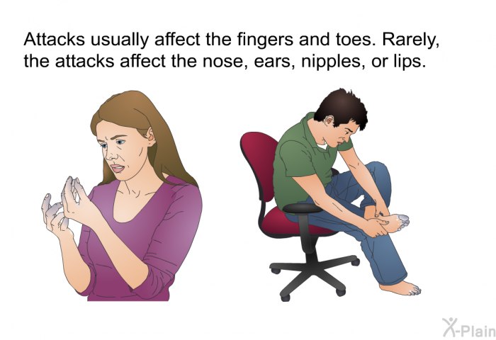 Attacks usually affect the fingers and toes. Rarely, the attacks affect the nose, ears, nipples, or lips.