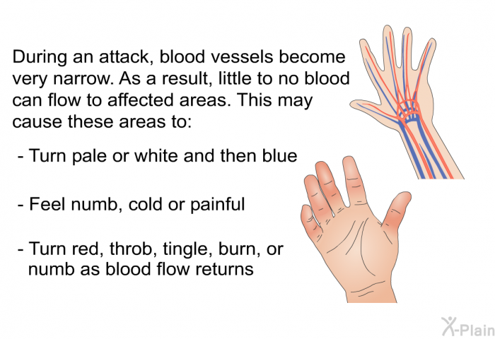 During an attack, blood vessels become very narrow. As a result, little to no blood can flow to affected areas. This may cause these areas to:  Turn pale or white and then blue Feel numb, cold or painful Turn red, throb, tingle, burn, or numb as blood flow returns
