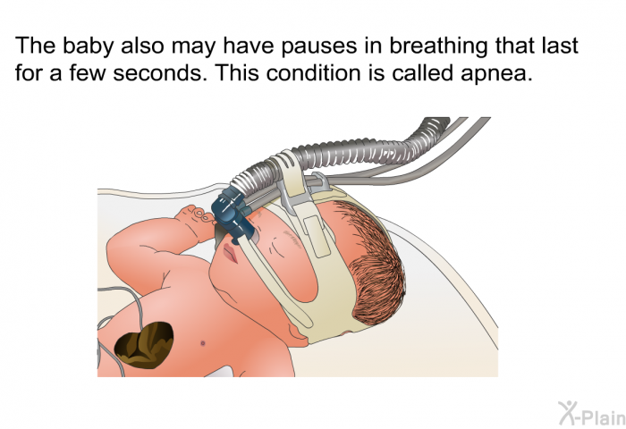 The baby also may have pauses in breathing that last for a few seconds. This condition is called apnea.