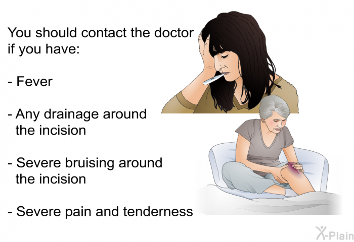 You should contact the doctor if you have:  Fever Any drainage around the incision Severe bruising around the incision Severe pain and tenderness