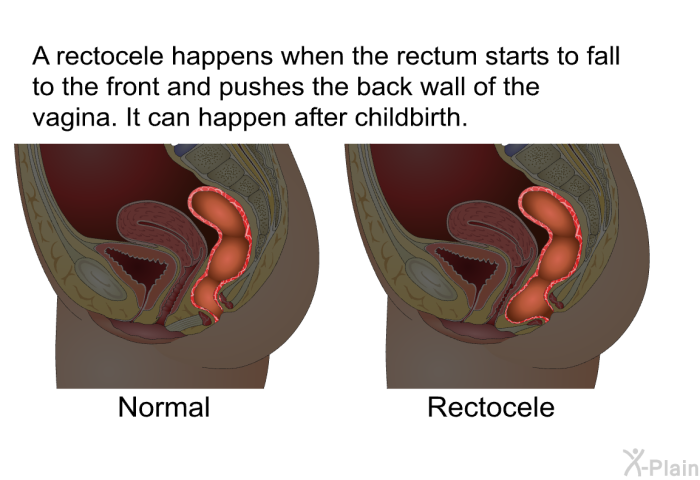 A rectocele happens when the rectum starts to fall to the front and pushes the back wall of the vagina. It can happen after childbirth.