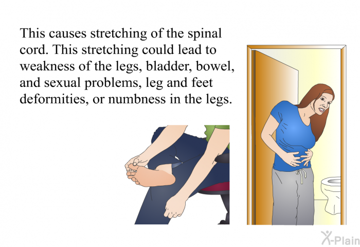 This causes stretching of the spinal cord. This stretching could lead to weakness of the legs, bladder, bowel, and sexual problems, leg and feet deformities, or numbness in the legs.