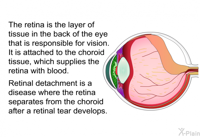 The retina is the layer of tissue in the back of the eye that is responsible for vision. It is attached to the choroid tissue, which supplies the retina with blood. Retinal detachment is a disease where the retina separates from the choroid after a retinal tear develops.