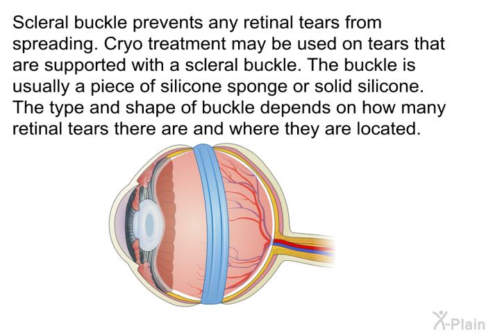 Scleral buckle prevents any retinal tears from spreading. Cryo treatment may be used on tears that are supported with a scleral buckle. The buckle is usually a piece of silicone sponge or solid silicone. The type and shape of buckle depends on how many retinal tears there are and where they are located.