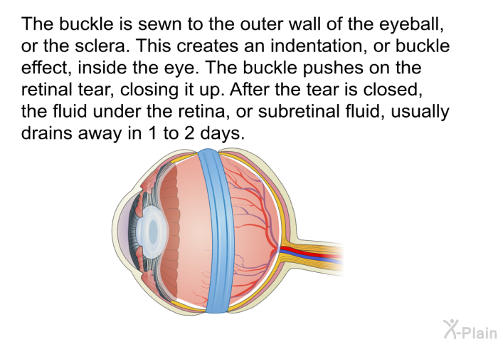 The buckle is sewn to the outer wall of the eyeball, or the sclera. This creates an indentation, or buckle effect, inside the eye. . The buckle pushes on the retinal tear, closing it up. After the tear is closed, the fluid under the retina, or subretinal fluid, usually drains away in 1 to 2 days.