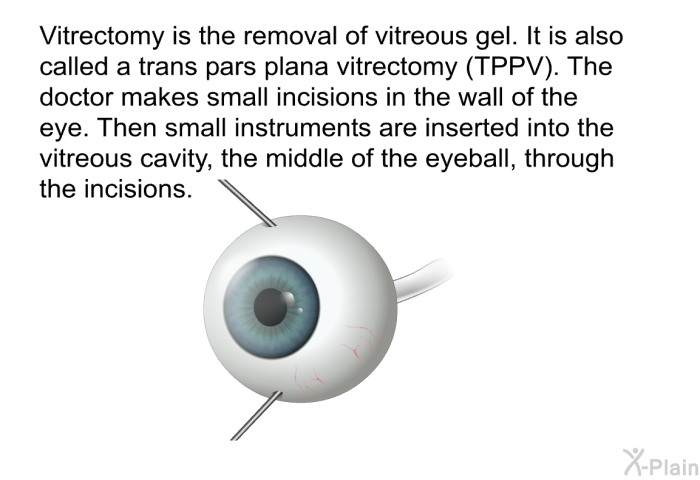 Vitrectomy is the removal of vitreous gel. It is also called a trans pars plana vitrectomy (TPPV). The doctor makes small incisions in the wall of the eye. Then small instruments are inserted into the vitreous cavity, the middle of the eyeball, through the incisions.