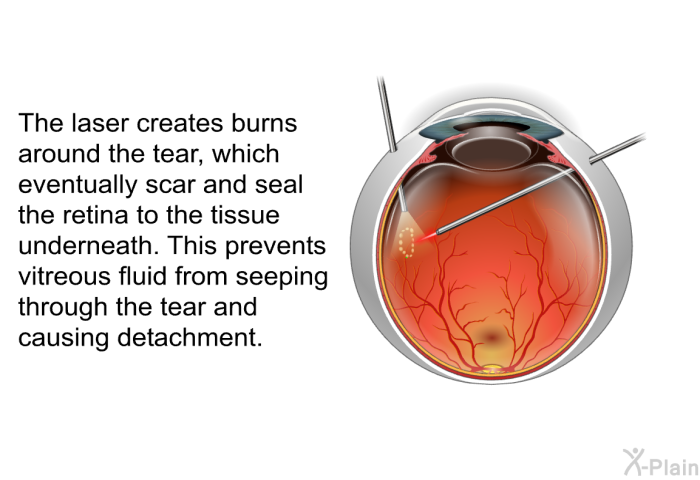 The laser creates burns around the tear, which eventually scar and seal the retina to the tissue underneath. This prevents vitreous fluid from seeping through the tear and causing detachment.