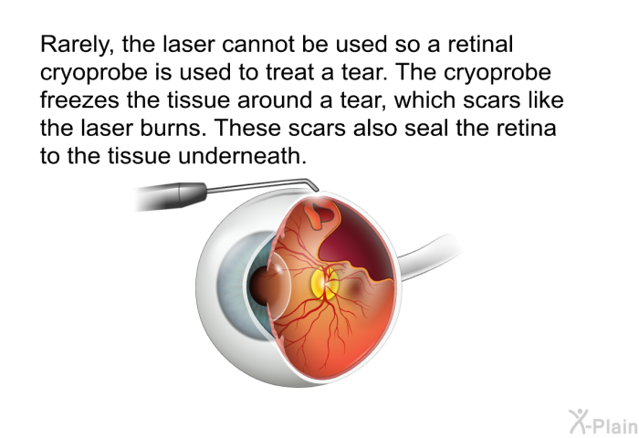 Rarely, the laser cannot be used so a retinal cryoprobe is used to treat a tear. The cryoprobe freezes the tissue around a tear, which scars like the laser burns. These scars also seal the retina to the tissue underneath.