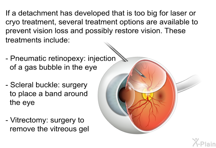 If a detachment has developed that is too big for laser or cryo treatment, several treatment options are available to prevent vision loss and possibly restore vision. These treatments include  Pneumatic retinopexy: injection of a gas bubble in the eye Scleral buckle: surgery to place a band around the eye Vitrectomy: surgery to remove the vitreous gel