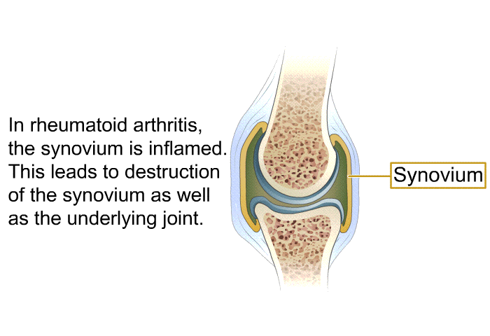 In rheumatoid arthritis, the synovium is inflamed. This leads to destruction of the synovium as well as the underlying joint.