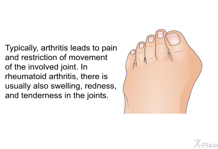 Typically, arthritis leads to pain and restriction of movement of the involved joint. In rheumatoid arthritis, there is usually also swelling, redness, and tenderness in the joints.