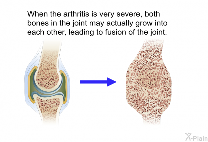 When the arthritis is very severe, both bones in the joint may actually grow into each other, leading to fusion of the joint.