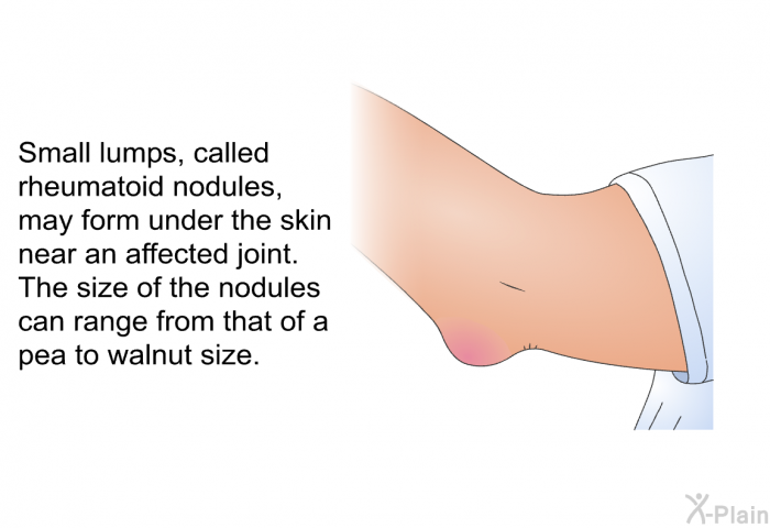 Small lumps, called rheumatoid nodules, may form under the skin near an affected joint. The size of the nodules can range from that of a pea to walnut size.
