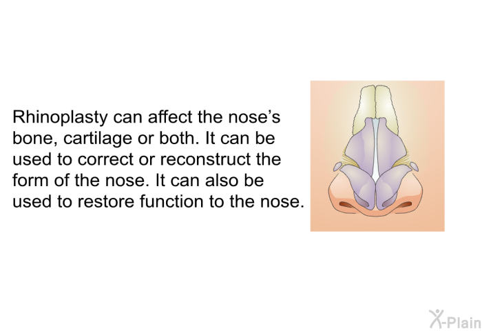 Rhinoplasty can affect the nose's bone, cartilage or both. It can be used to correct or reconstruct the form of the nose. It can also be used to restore function to the nose.