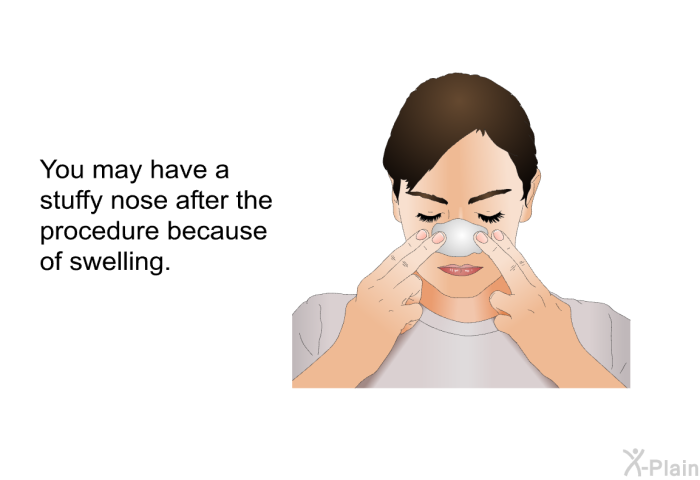 You may have a stuffy nose after the procedure because of swelling.