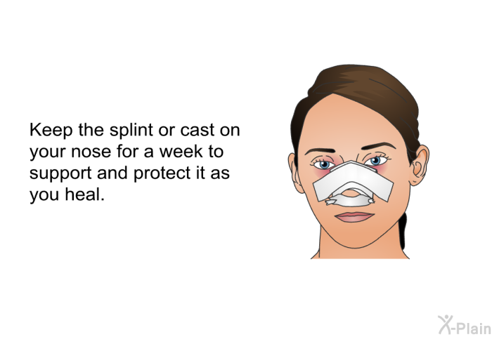 Keep the splint or cast on your nose for a week to support and protect it as you heal.
