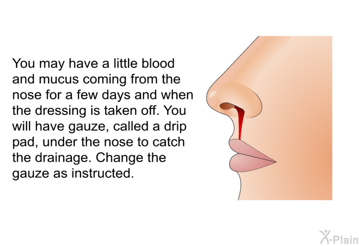 You may have a little blood and mucus coming from the nose for a few days and when the dressing is taken off. You will have gauze, called a drip pad, under the nose to catch the drainage. Change the gauze as instructed.