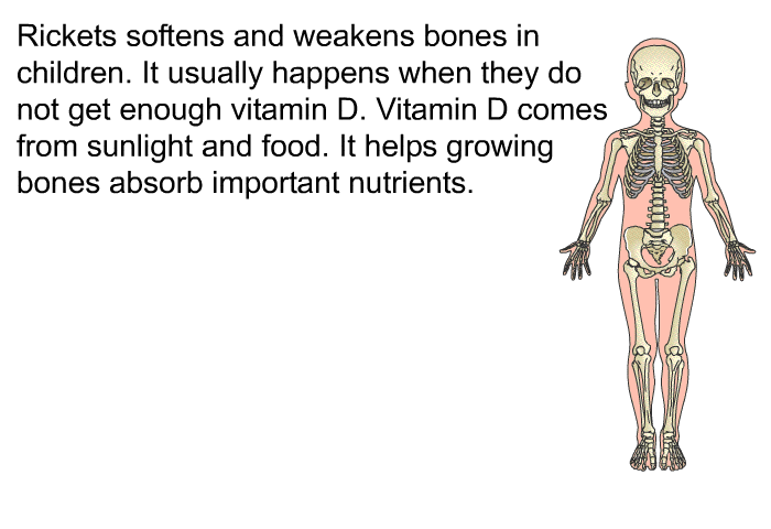 Rickets softens and weakens bones in children. It usually happens when they do not get enough vitamin D. Vitamin D comes from sunlight and food. It helps growing bones absorb important nutrients.