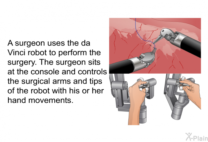 A surgeon uses the da Vinci robot to perform the surgery. The surgeon sits at the console and controls the surgical arms and tips of the robot with his or her hand movements.