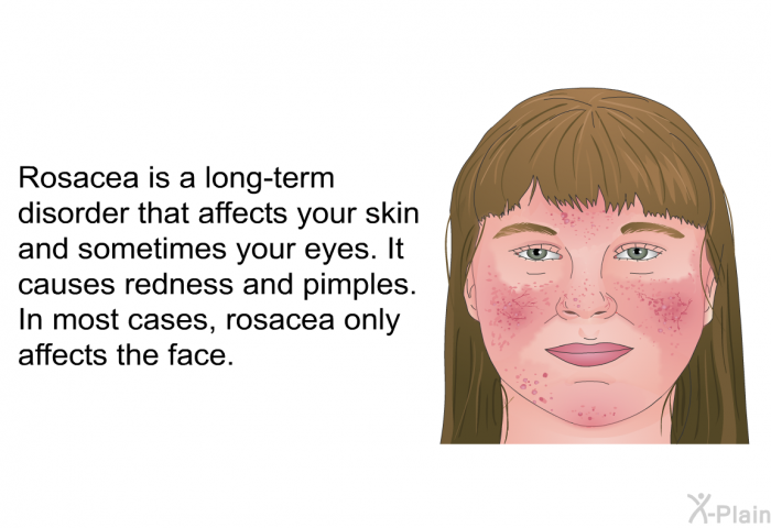 Rosacea is a long-term disorder that affects your skin and sometimes your eyes. It causes redness and pimples. In most cases, rosacea only affects the face.